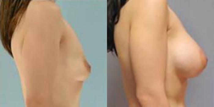 Before & After Breast Augmentation Case 4882 View 3 View in Houston, TX
