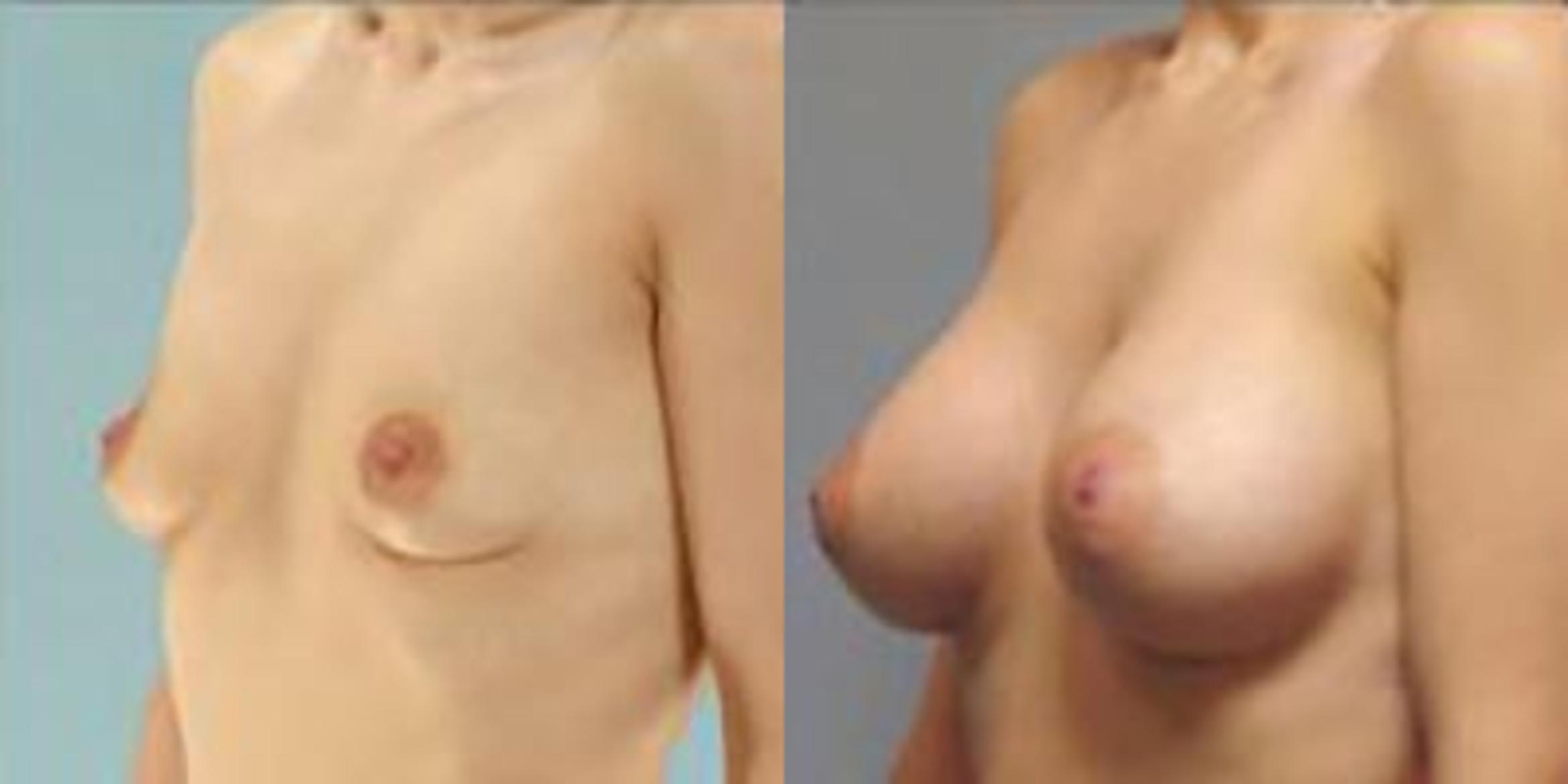 Before & After Breast Augmentation Case 4882 View 4 View in Houston, TX