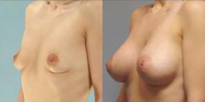 Before & After Breast Augmentation Case 4882 View 4 View in Houston, TX