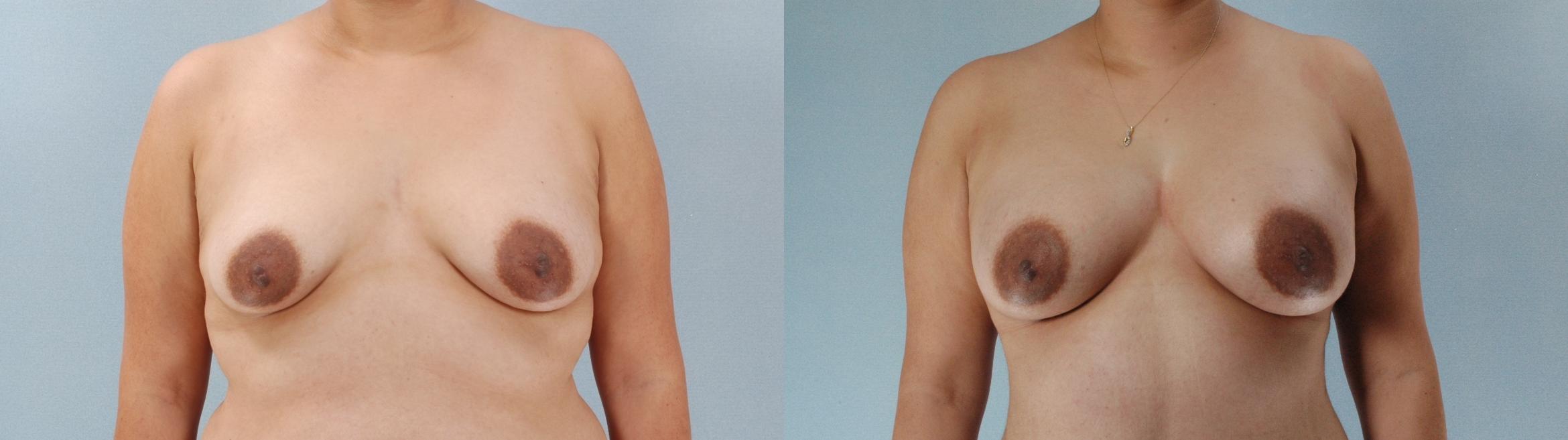 Before & After Breast Augmentation Case 613875210001 Front View in Houston, TX