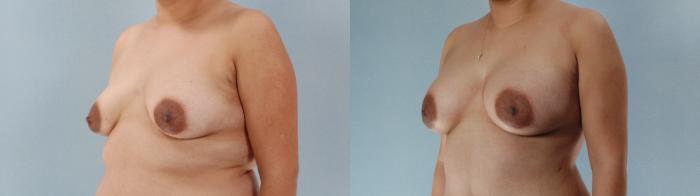 Before & After Breast Augmentation Case 613875210001 Left Oblique View in Houston, TX