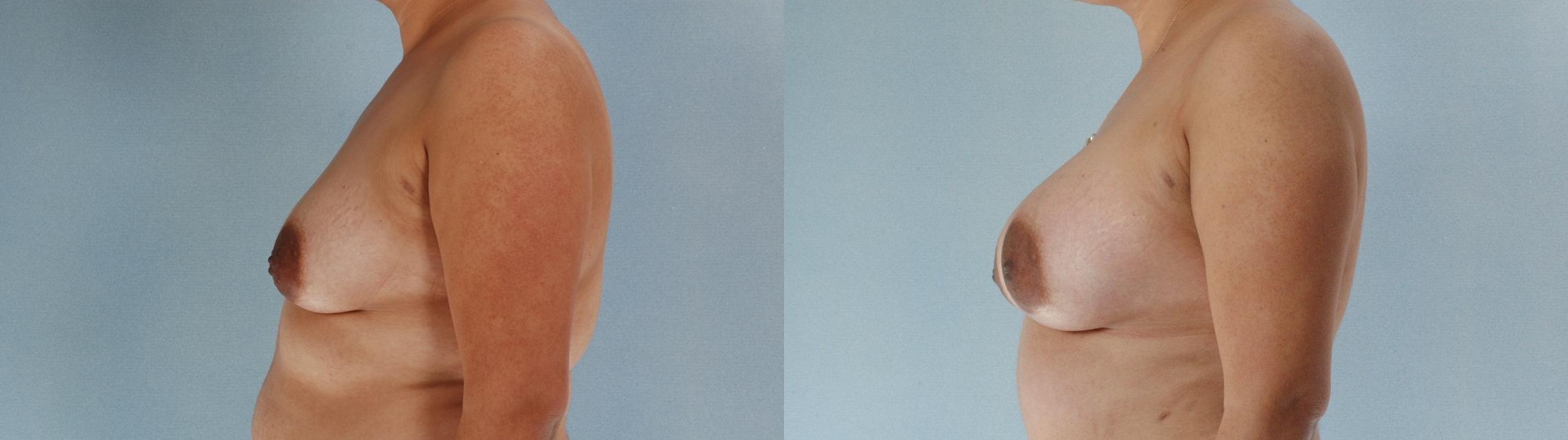 Before & After Breast Augmentation Case 613875210001 Left Side View in Houston, TX