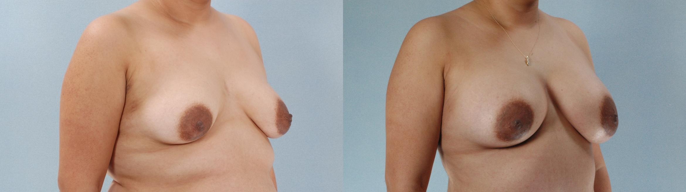 Before & After Breast Augmentation Case 613875210001 Right Oblique View in Houston, TX