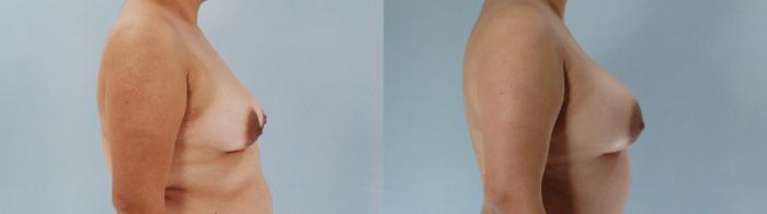 Before & After Breast Augmentation Case 613875210001 Right Side View in Houston, TX