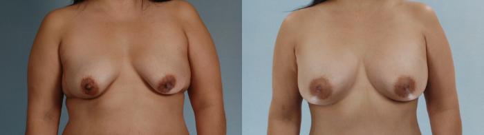 Before & After Liposuction Case 613875210006 Front View in Houston, TX