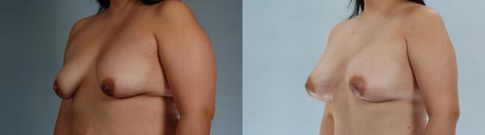 Before & After Liposuction Case 613875210006 Left Oblique View in Houston, TX