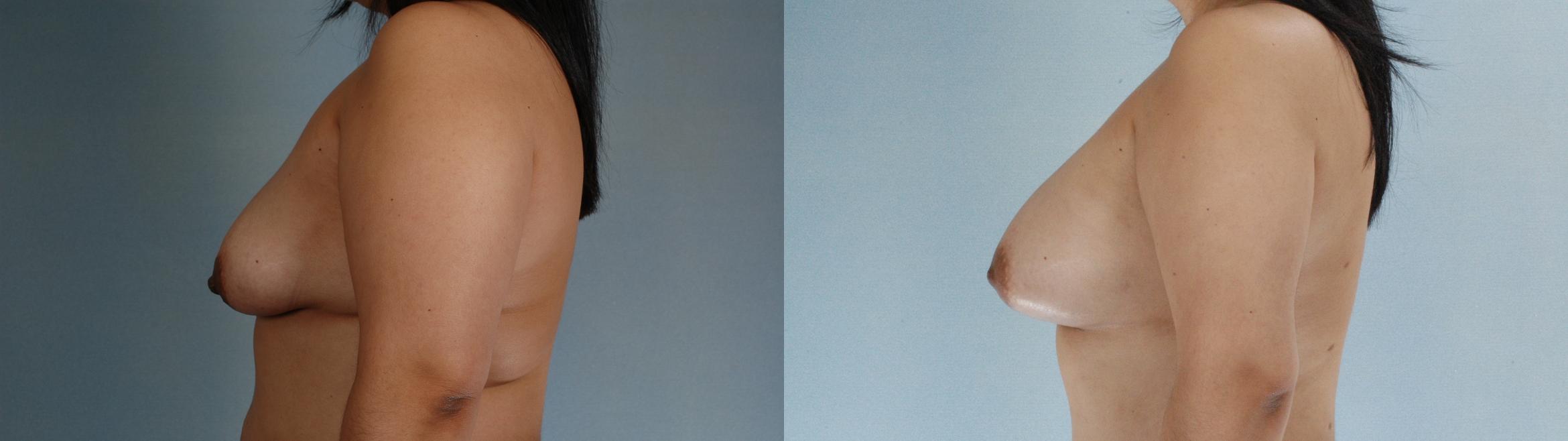 Before & After Liposuction Case 613875210006 Left Side View in Houston, TX