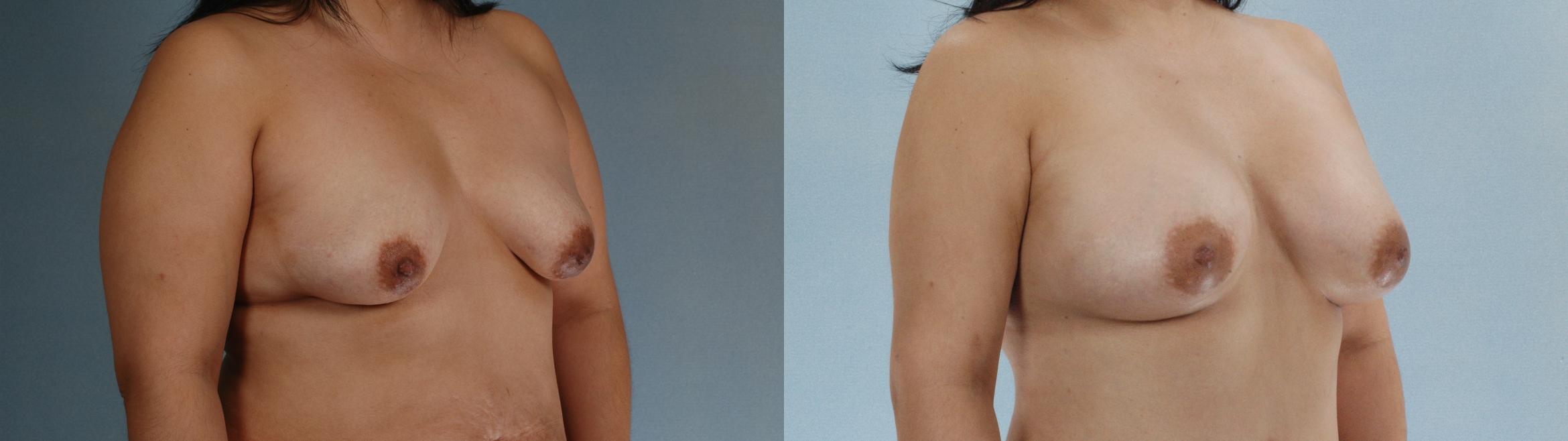 Before & After Liposuction Case 613875210006 Right Oblique View in Houston, TX