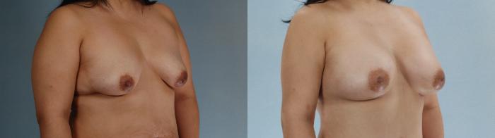Before & After Liposuction Case 613875210006 Right Oblique View in Houston, TX