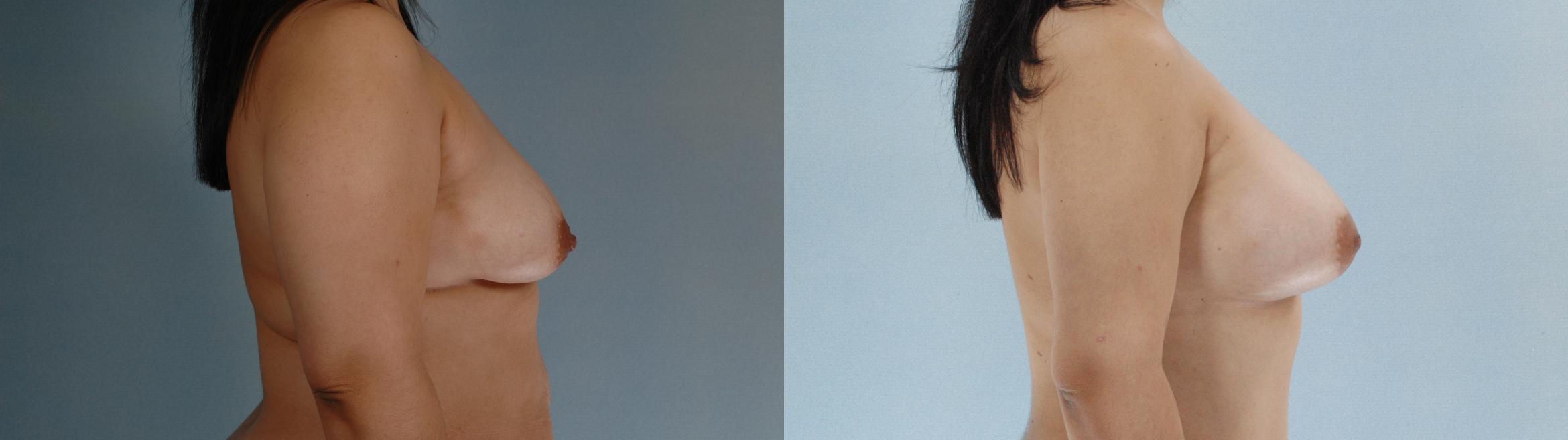 Before & After Liposuction Case 613875210006 Right Side View in Houston, TX