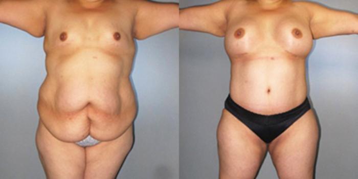 Before & After Breast Augmentation Case 82899999 View 1 View in Houston, TX