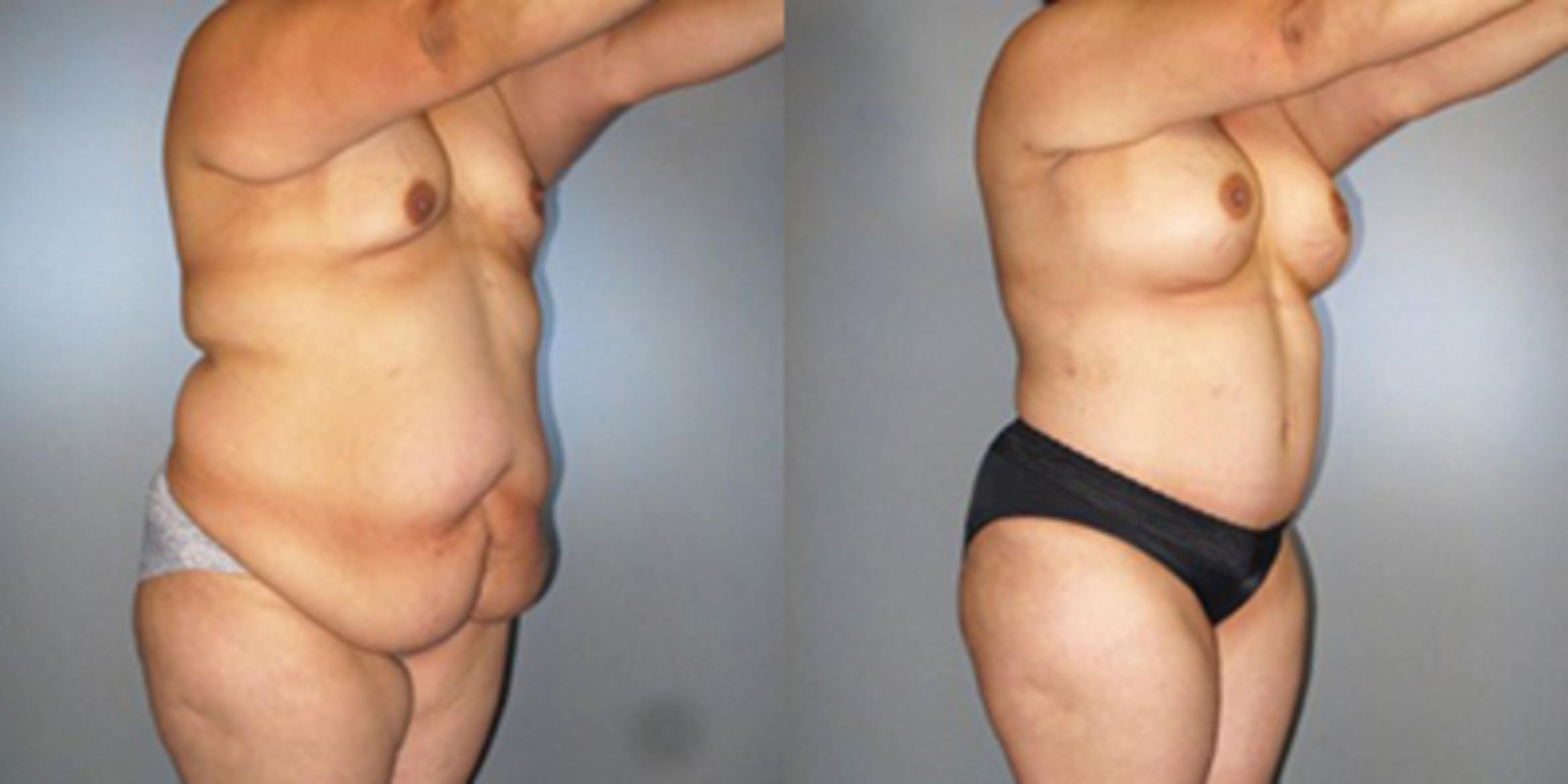 Before & After Breast Augmentation Case 82899999 View 2 View in Houston, TX