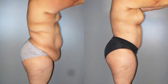 Before & After Breast Augmentation Case 82899999 View 3 View in Houston, TX