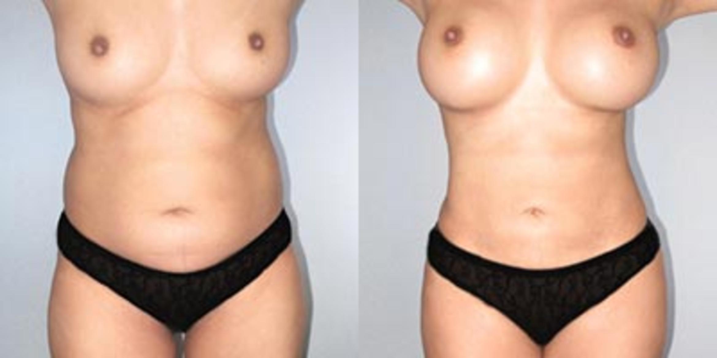 Before & After Breast Augmentation Case 9367 View 1 View in Houston, TX
