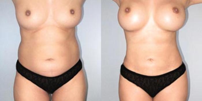 Before & After Breast Augmentation Case 9367 View 1 View in Houston, TX