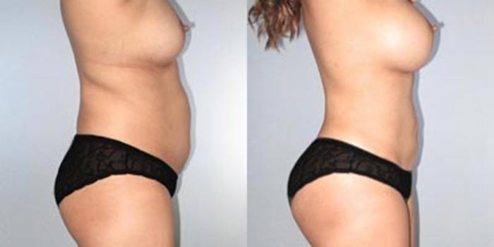 Before & After Breast Augmentation Case 9367 View 2 View in Houston, TX