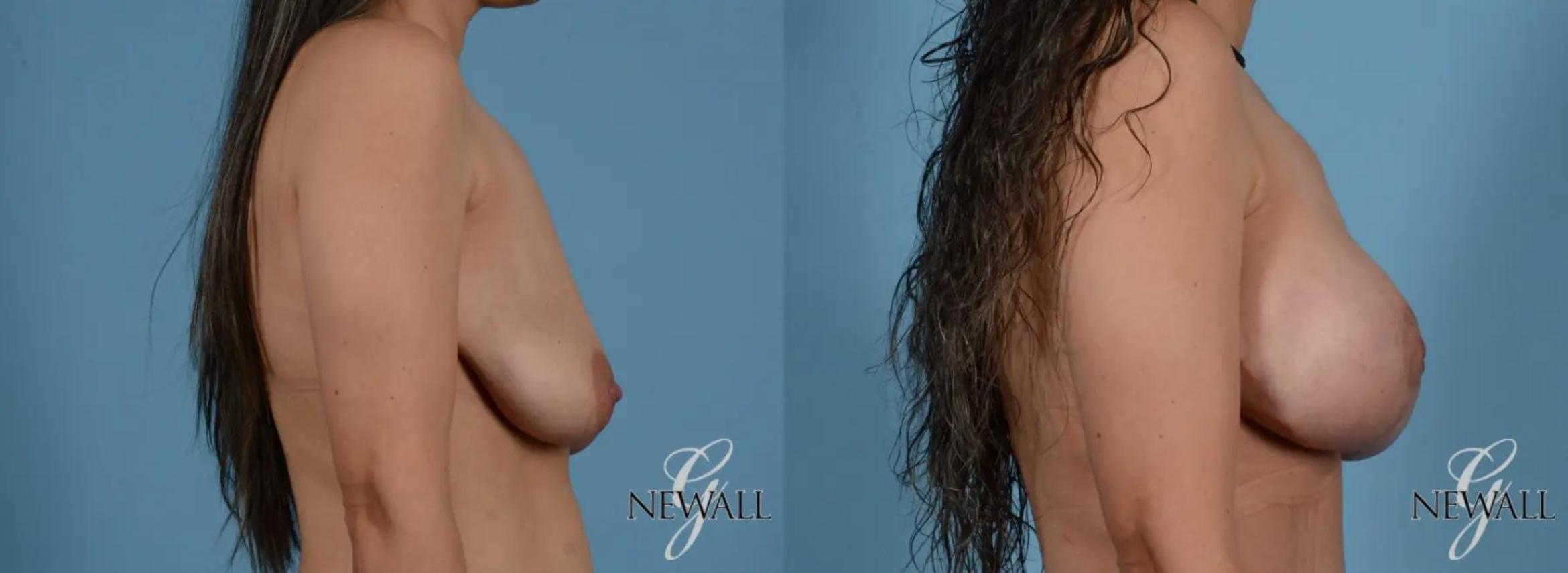 Before & After Breast Augmentation with Lift Case 16976 View 2 View in Houston, TX