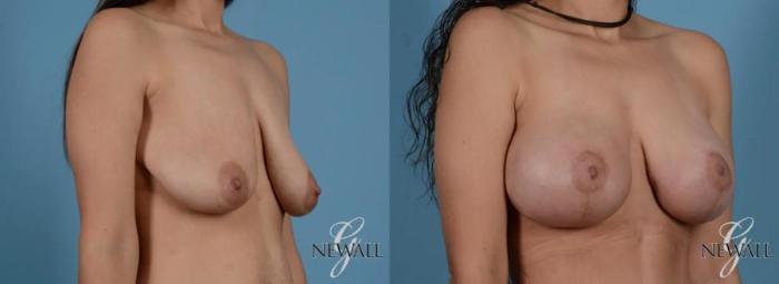 Before & After Breast Augmentation with Lift Case 16976 View 3 View in Houston, TX