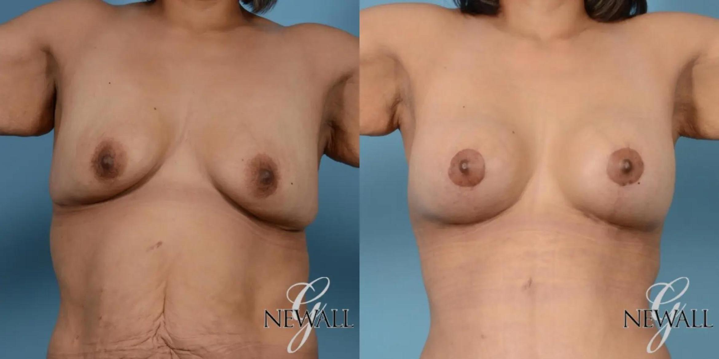 Before & After Breast Augmentation with Lift Case 17444 View 1 View in Houston, TX