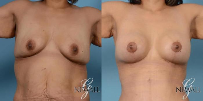 Before & After Breast Augmentation with Lift Case 17444 View 1 View in Houston, TX