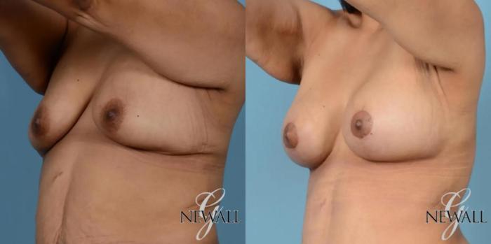 Before & After Breast Augmentation with Lift Case 17444 View 2 View in Houston, TX