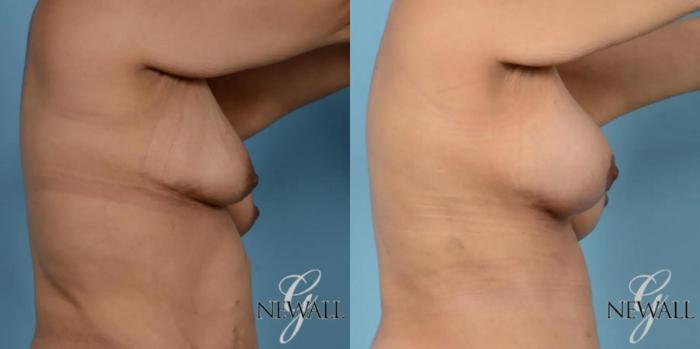 Before & After Breast Augmentation with Lift Case 17444 View 3 View in Houston, TX