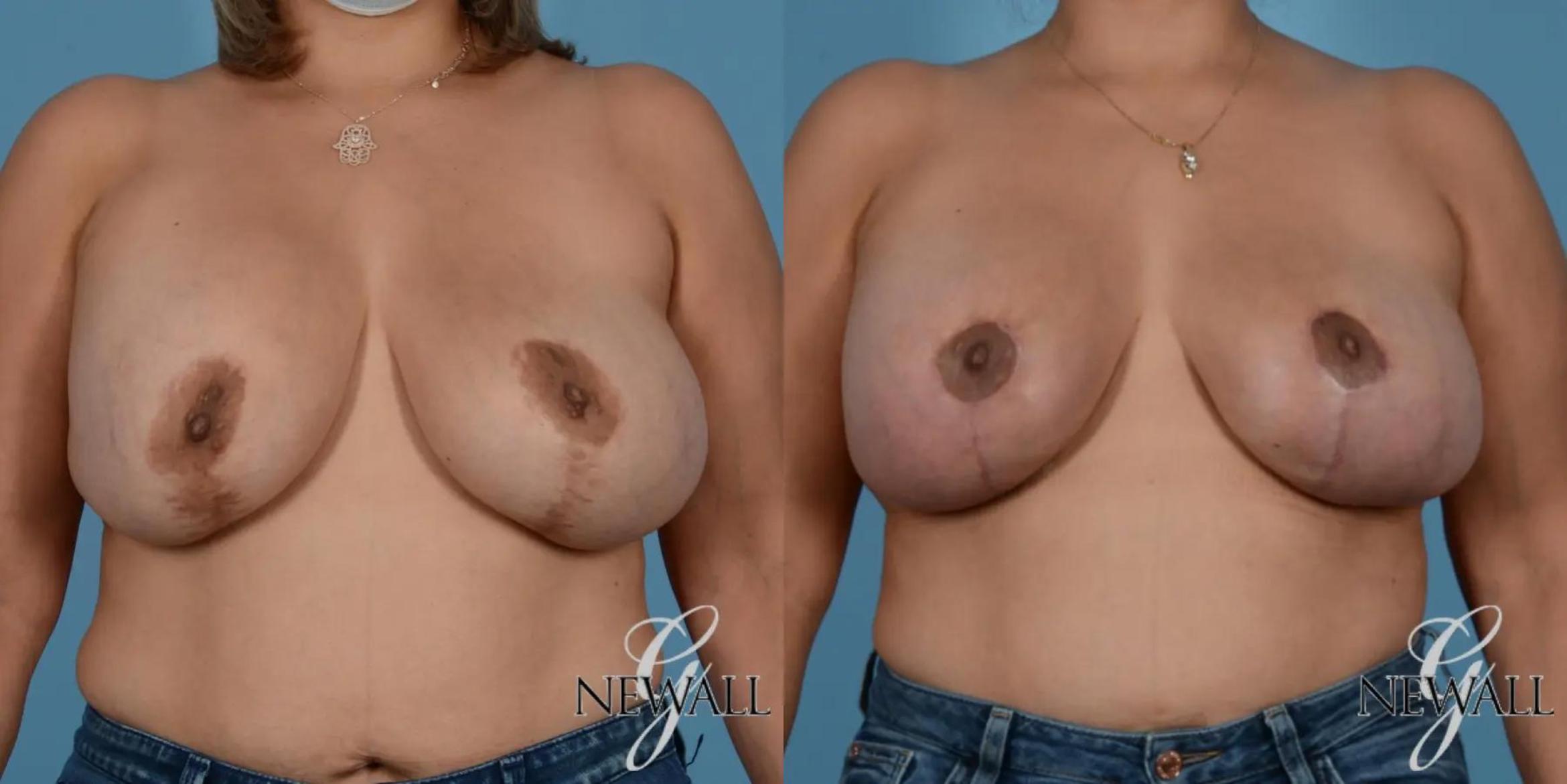 Before & After Breast Augmentation with Lift Case 17761 View 1 View in Houston, TX
