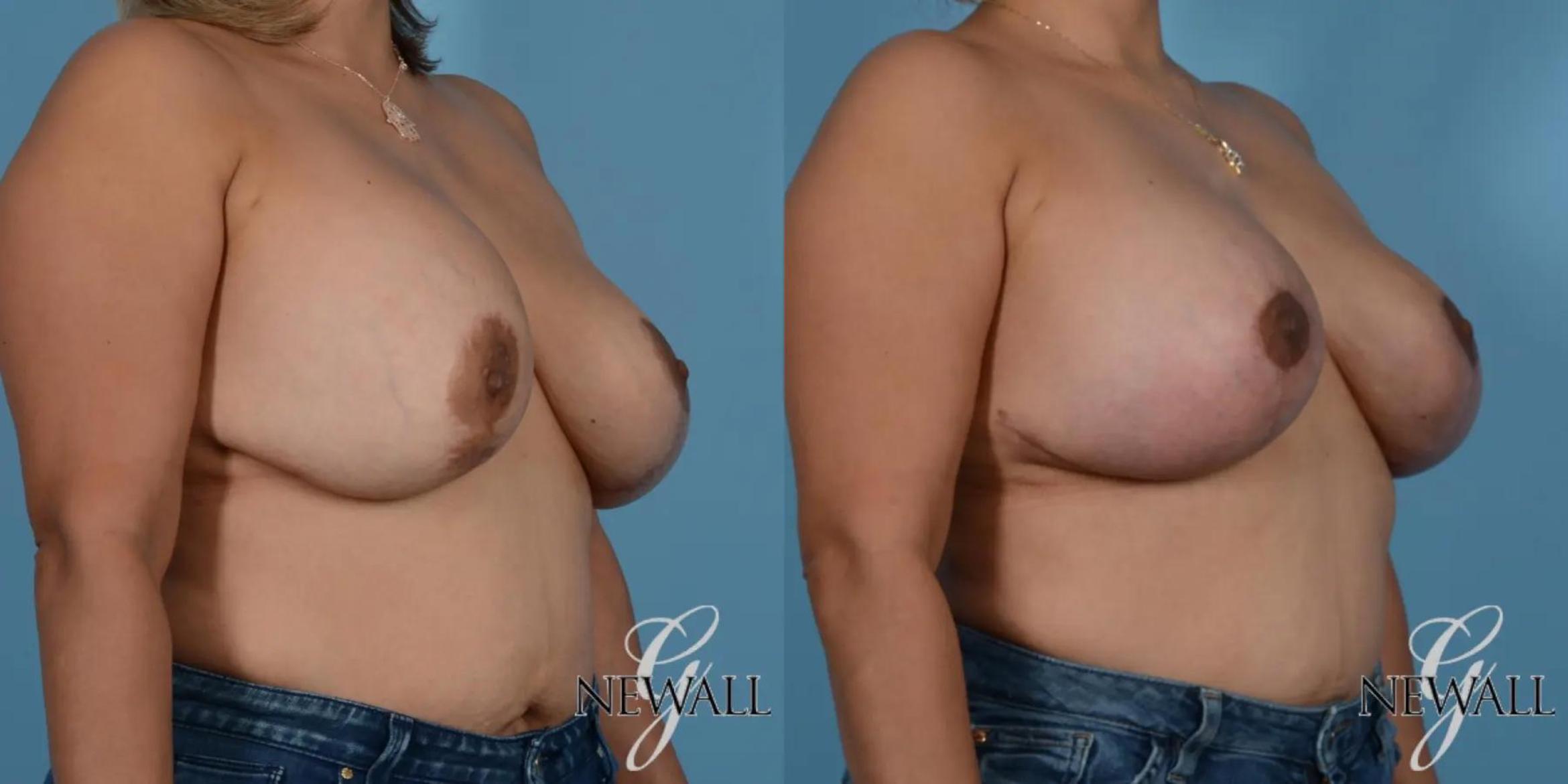 Before & After Breast Augmentation with Lift Case 17761 View 2 View in Houston, TX