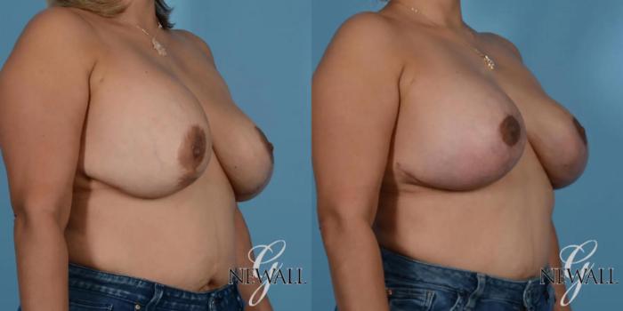 Before & After Breast Augmentation with Lift Case 17761 View 2 View in Houston, TX