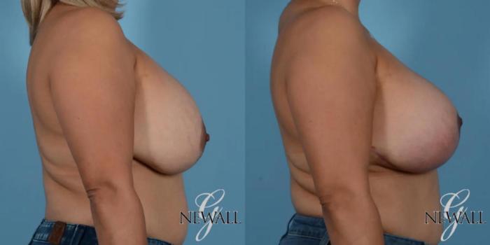 Before & After Breast Augmentation with Lift Case 17761 View 3 View in Houston, TX