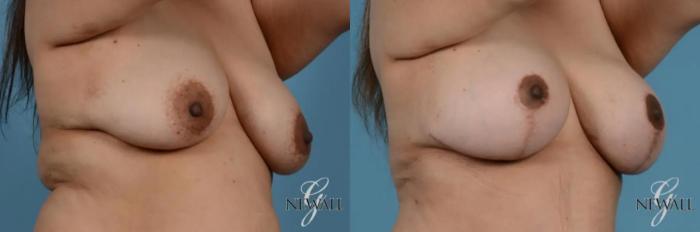 Before & After Breast Augmentation with Lift Case 17850 View 2 View in Houston, TX