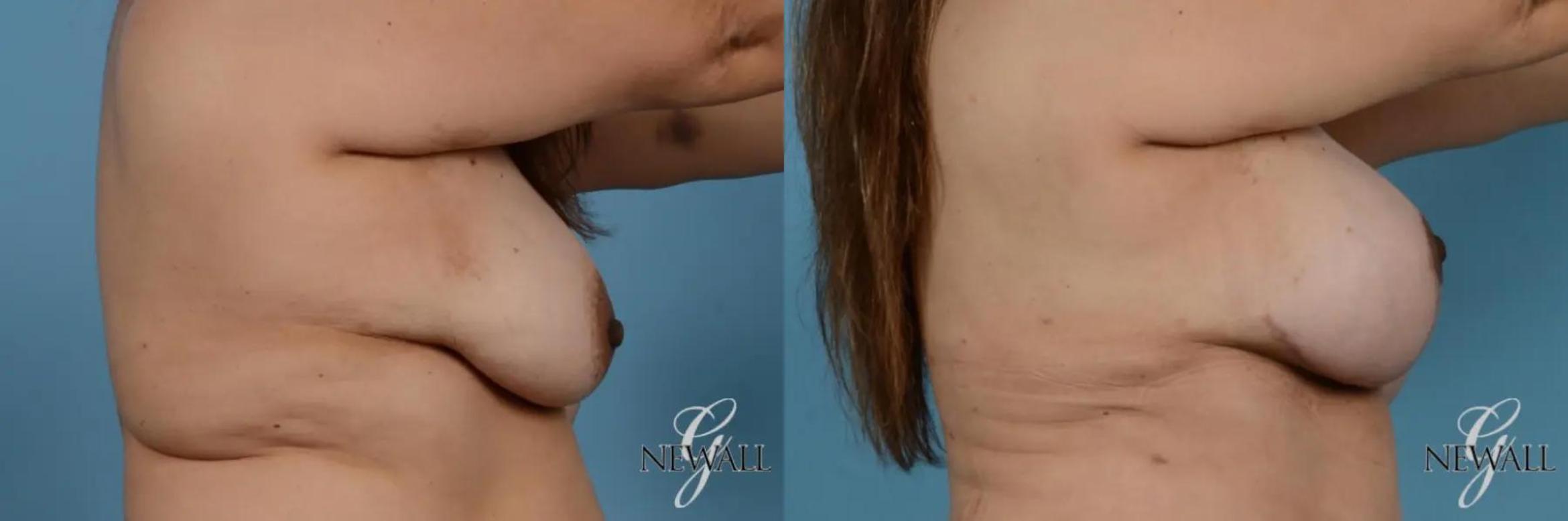 Before & After Breast Augmentation with Lift Case 17850 View 3 View in Houston, TX