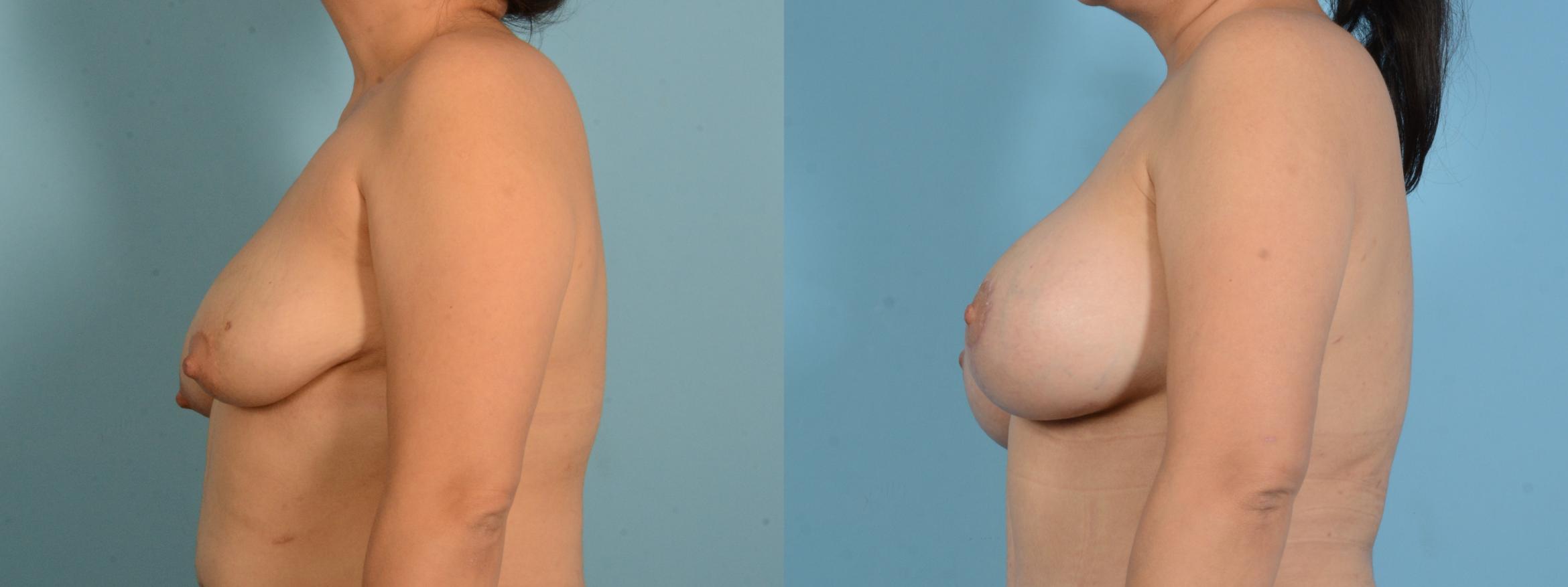 Before & After Breast Augmentation with Lift Case 18140 Left View in Houston, TX