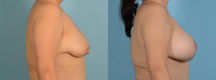 Before & After Breast Augmentation with Lift Case 18140 Right View in Houston, TX