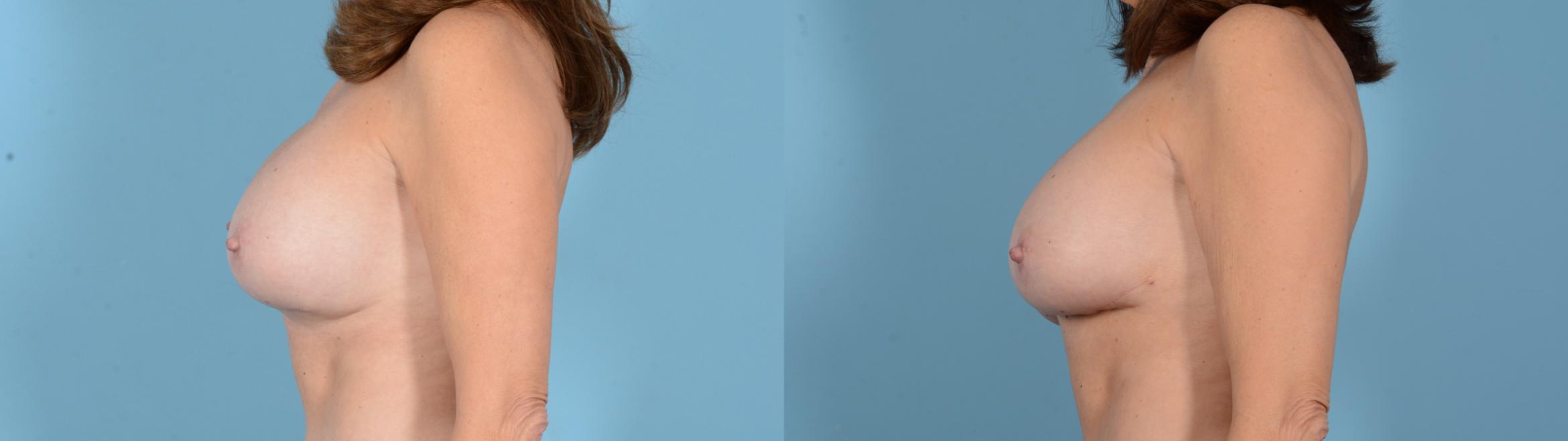 Before & After Breast Implant Exchange Case 18130 Left View in Houston, TX