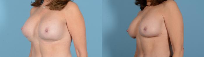 Before & After Breast Implant Exchange Case 18130 Left Oblique View in Houston, TX