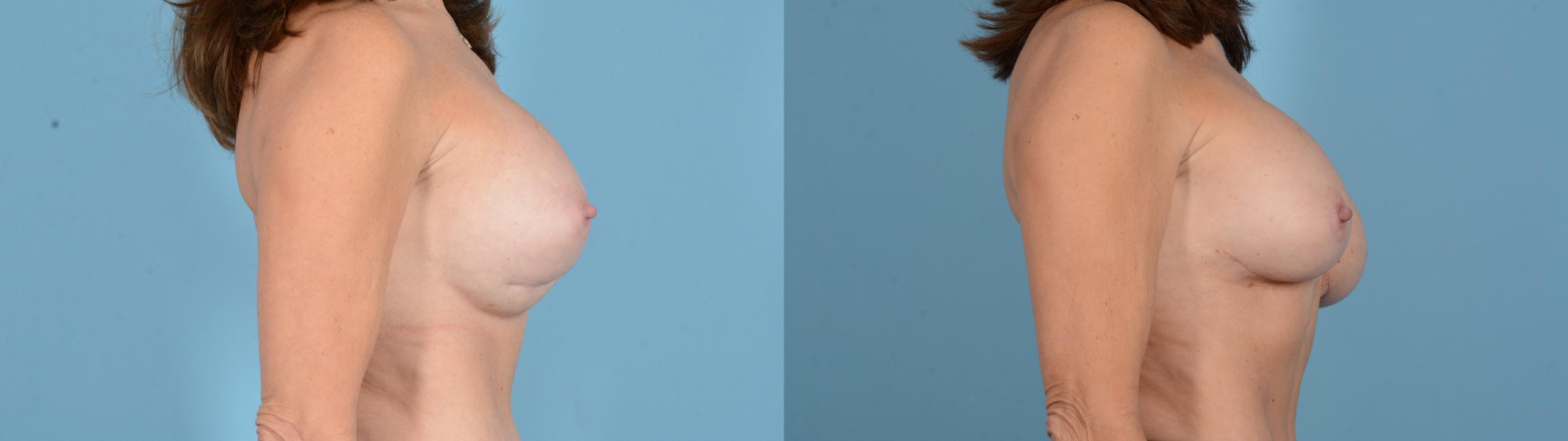 Before & After Breast Implant Exchange Case 18130 Left Side View in Houston, TX
