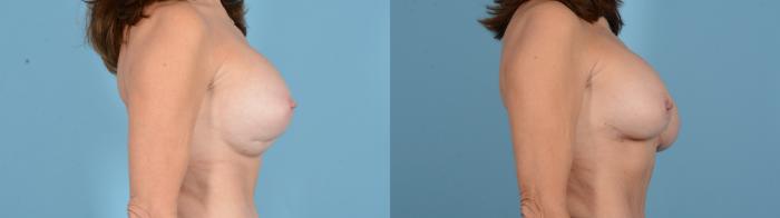Before & After Breast Implant Exchange Case 18130 Left Side View in Houston, TX