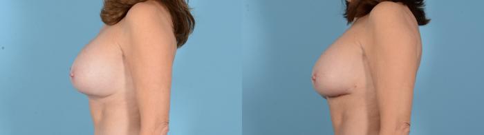 Before & After Breast Implant Exchange Case 18130 Left View in Houston, TX