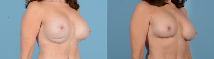 Before & After Breast Implant Exchange Case 18130 Right Oblique View in Houston, TX