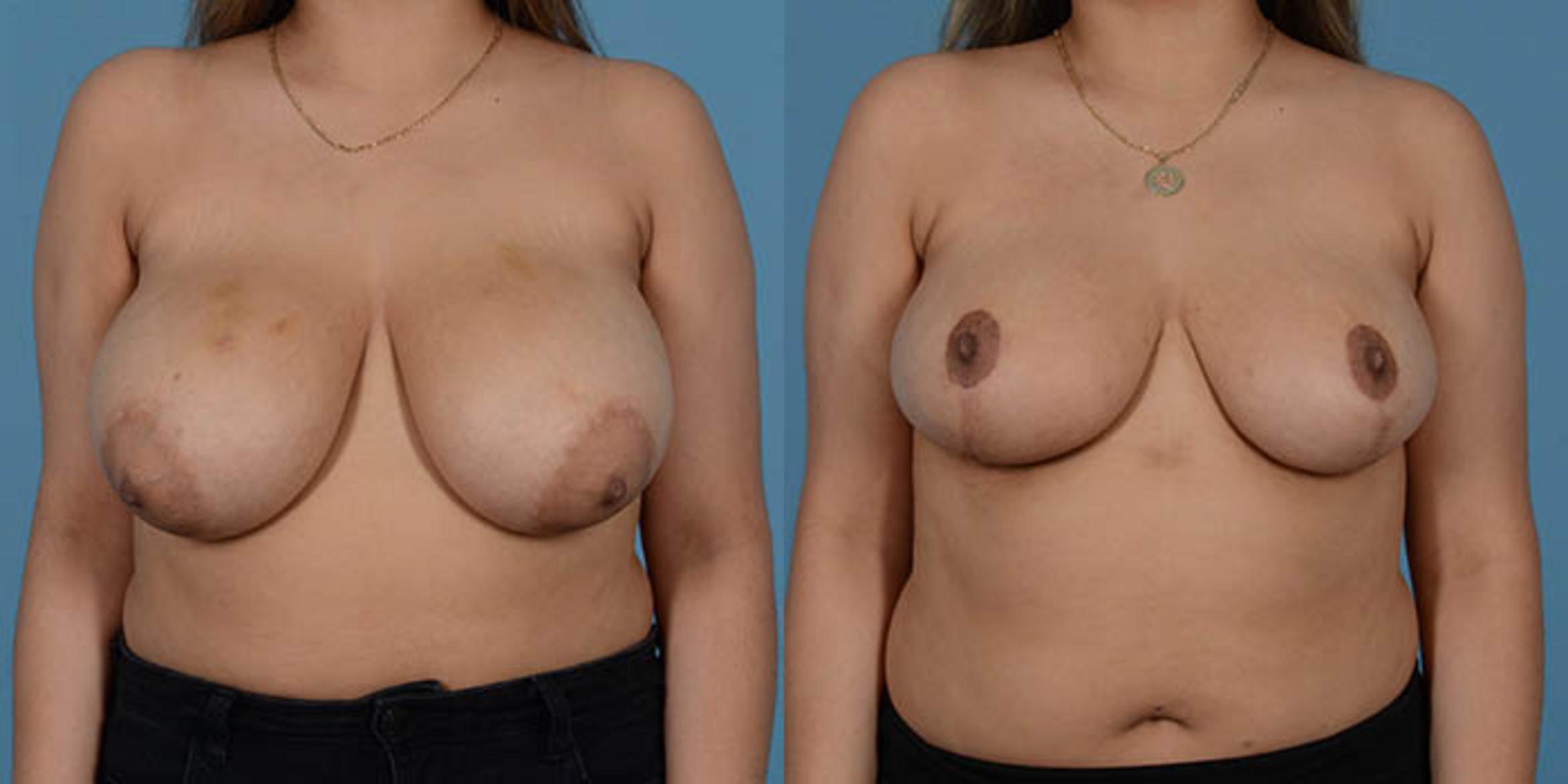 Before & After Breast Lift Case 137196 View 1 View in Houston, TX