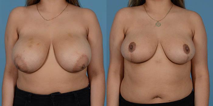 Before & After Breast Lift Case 137196 View 1 View in Houston, TX