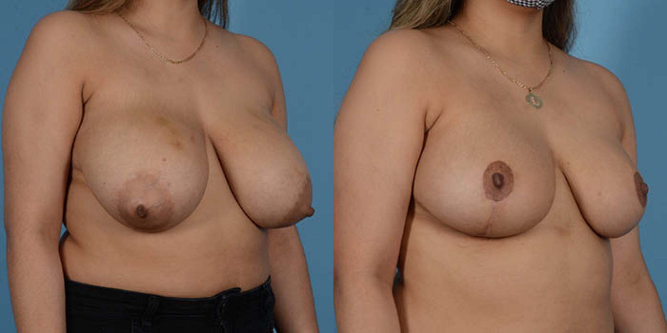 Before & After Breast Lift Case 137196 View 2 View in Houston, TX