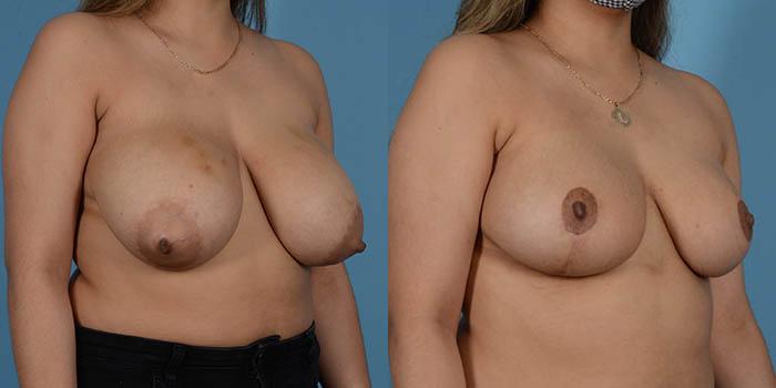 Before & After Breast Lift Case 137196 View 2 View in Houston, TX