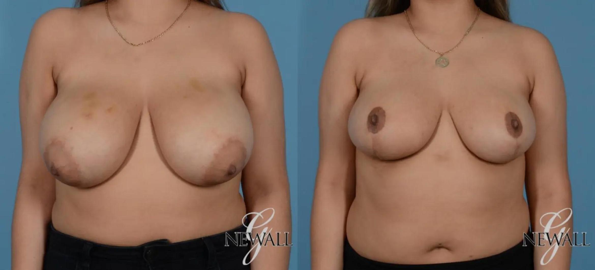 Before & After Breast Lift Case 16991 View 1 View in Houston, TX