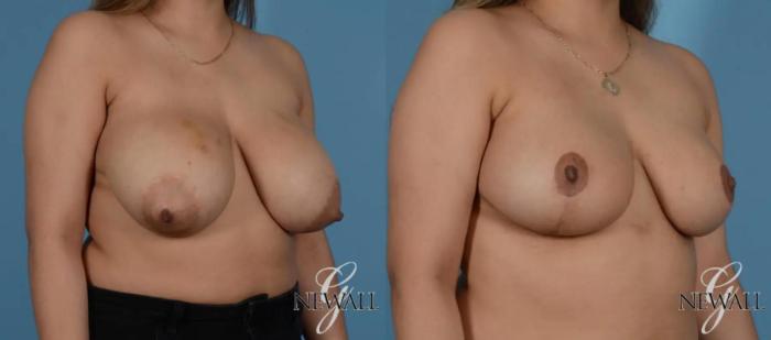Before & After Breast Lift Case 16991 View 3 View in Houston, TX