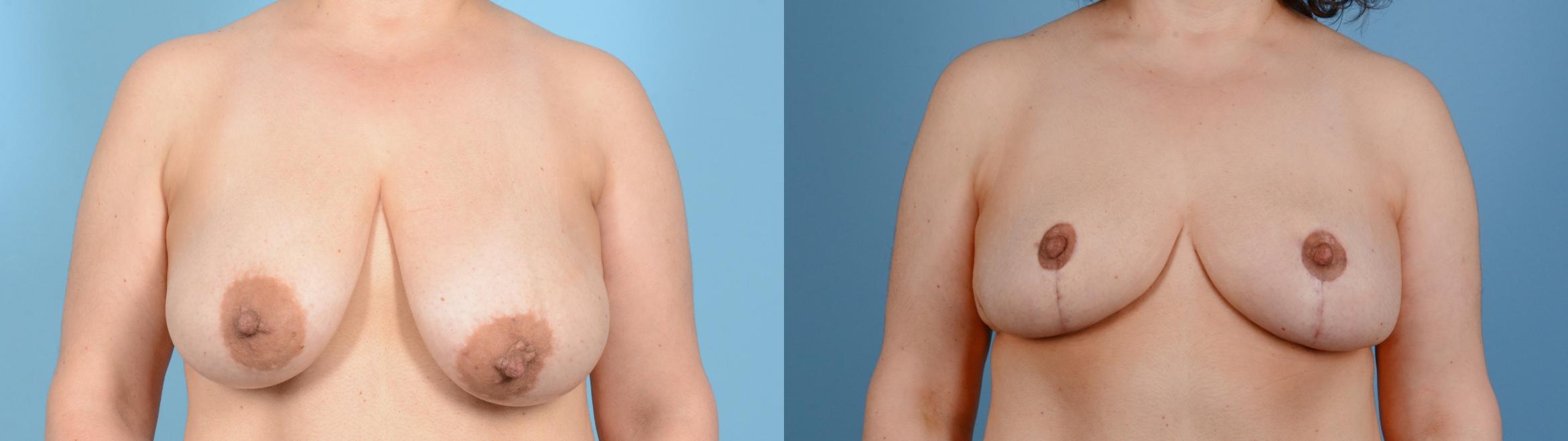 Before & After Breast Lift Case 18131 Front View in Houston, TX
