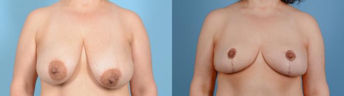 Before & After Breast Lift Case 18131 Front View in Houston, TX
