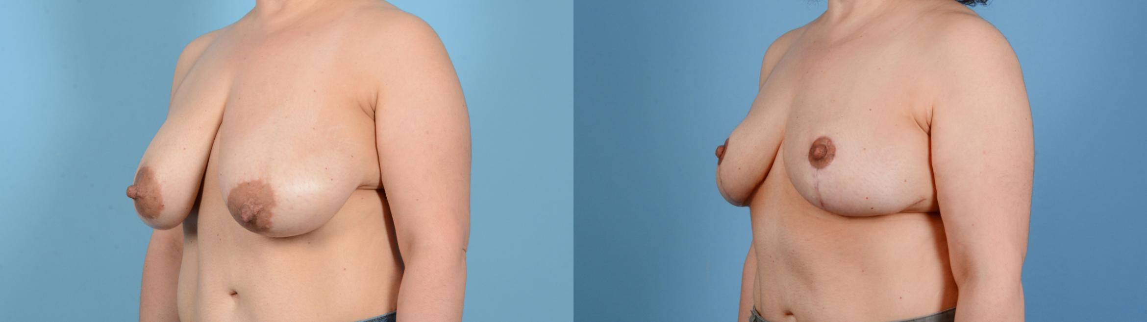 Before & After Breast Lift Case 18131 Left Oblique View in Houston, TX