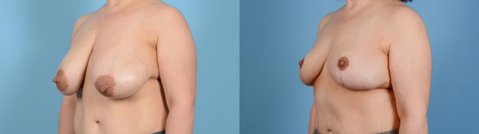 Before & After Breast Lift Case 18131 Left Oblique View in Houston, TX